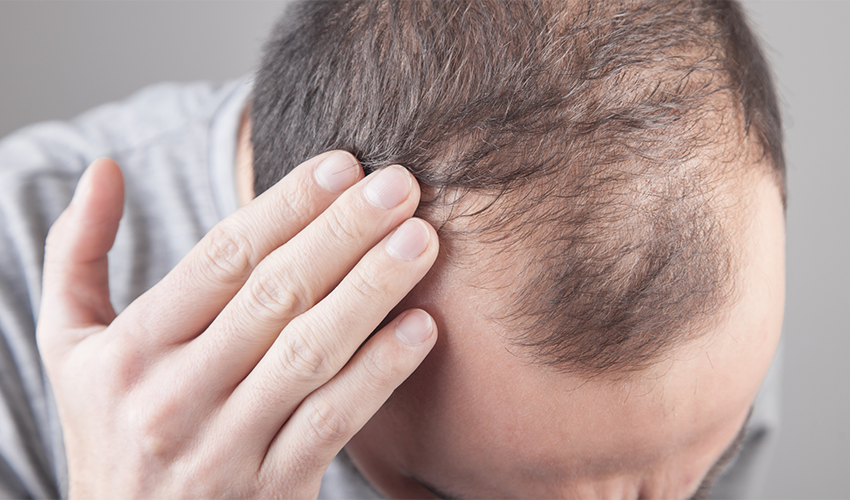 Which is Preferable for Hair Loss - RU58841 or Finasteride?